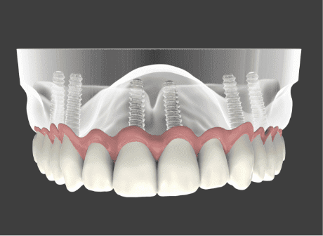 Dental Implant Salinas, CA